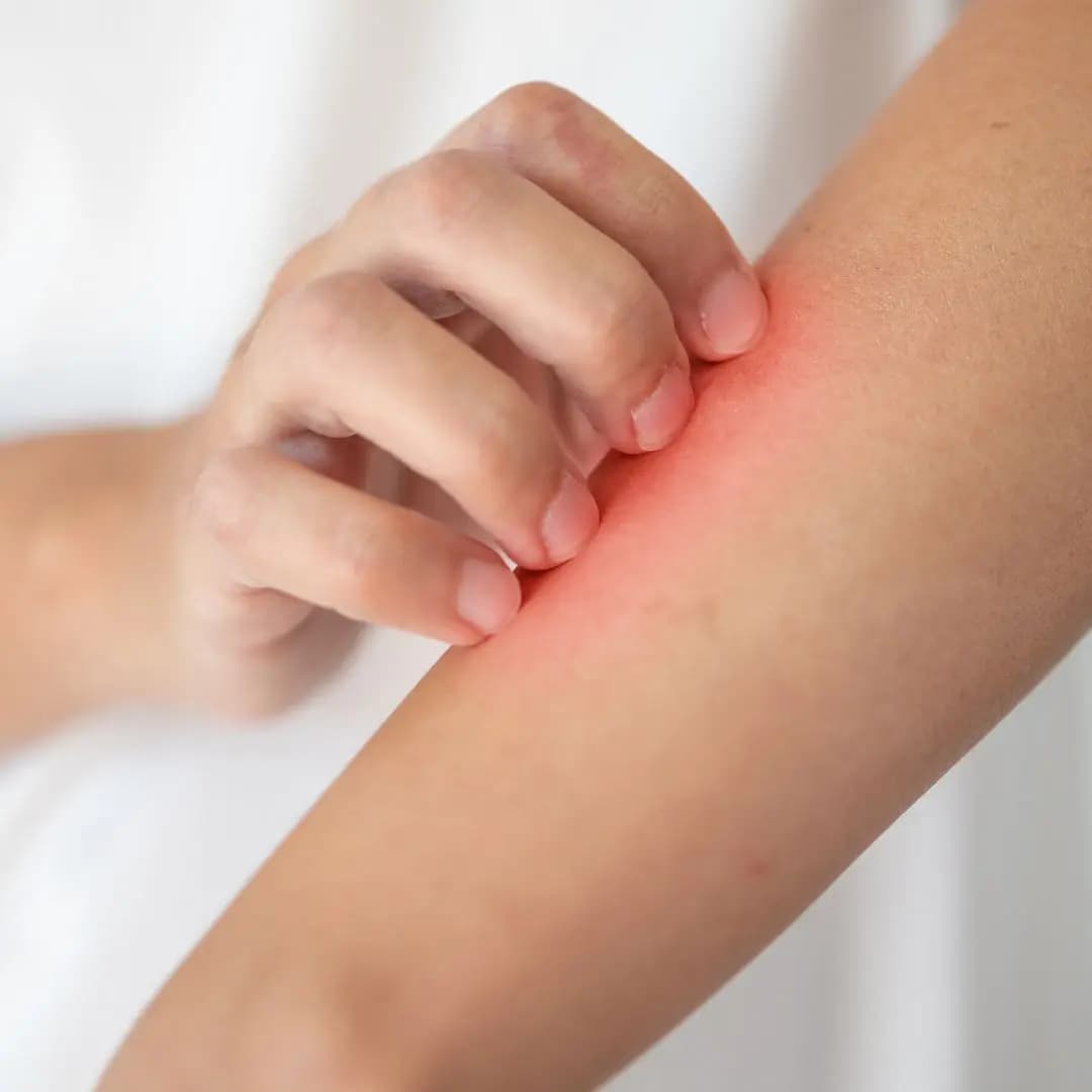 Kidney Disease Itching: Causes, Symptoms, and Treatment