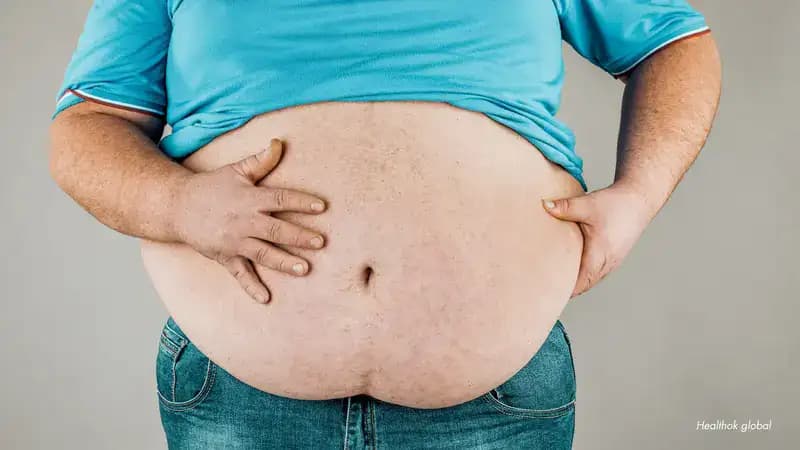 Obesity Explained: Causes, Classes, Diagnosis & Management