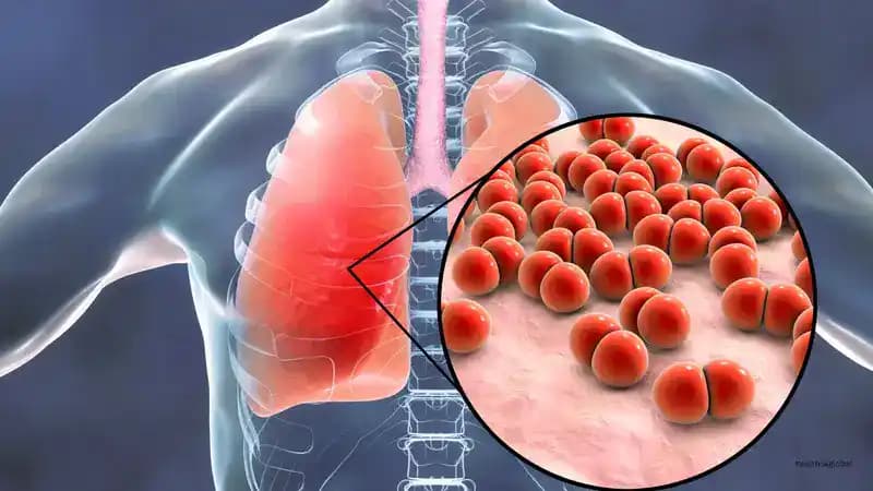 Pathogenesis of Pneumonia: Mechanisms and Implications