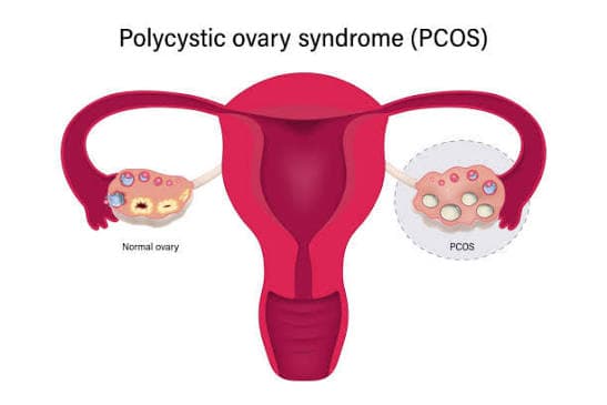 PCOS Symptoms, Diagnosis & Treatment: What Women Should Know