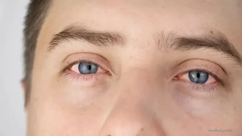 What Causes Eye Flu? Viral, Bacterial, Allergic and Irritant Triggers Explained