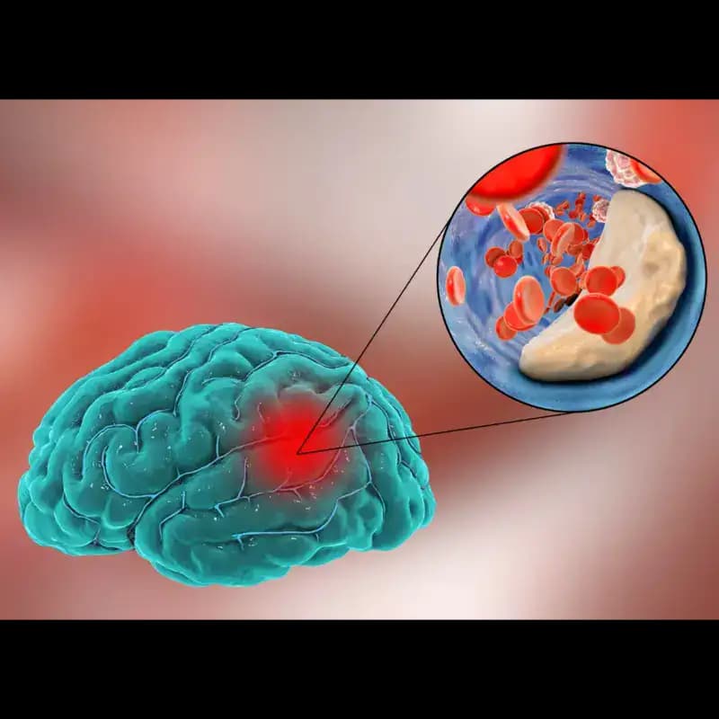 Brain Clot Treatment and Recovery: Proven Methods with Case Studies