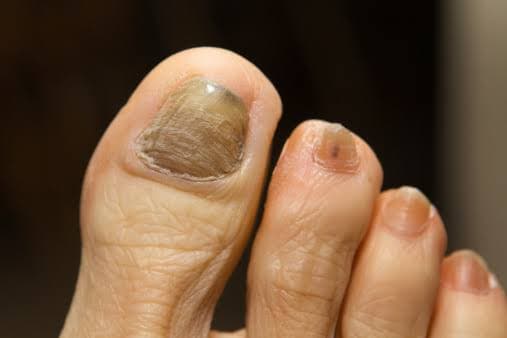 Black Toenails in Diabetes: When to Seek Medical A