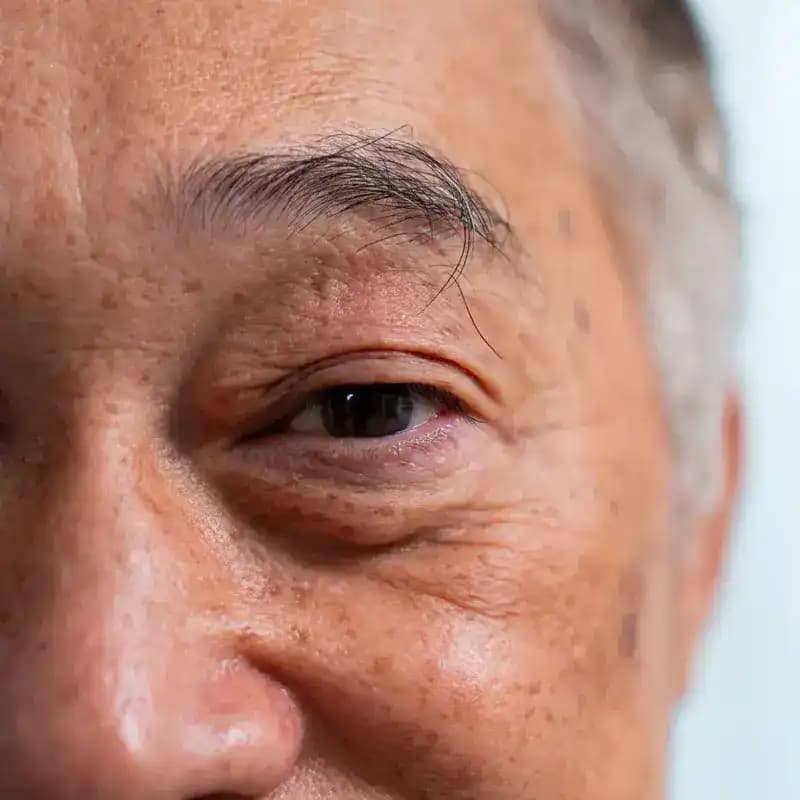 Posterior Subcapsular Cataract: Symptoms, Causes & Care