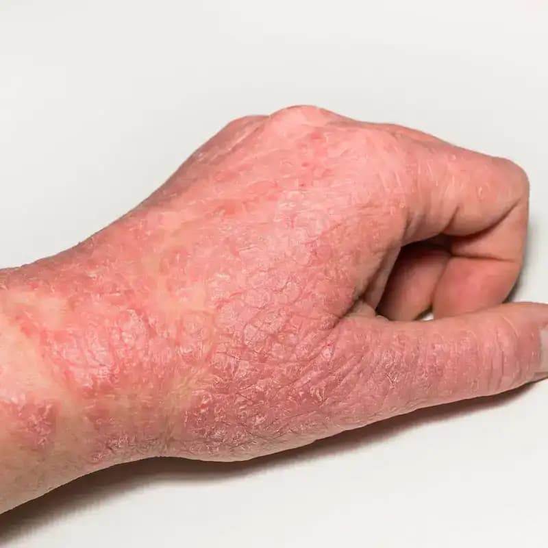 Cystic Lesion: Understanding Causes, Symptoms, and Treatment