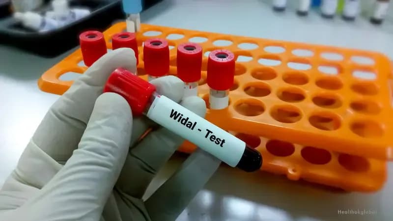 Widal Test Positive Means: Interpretation and Next Steps