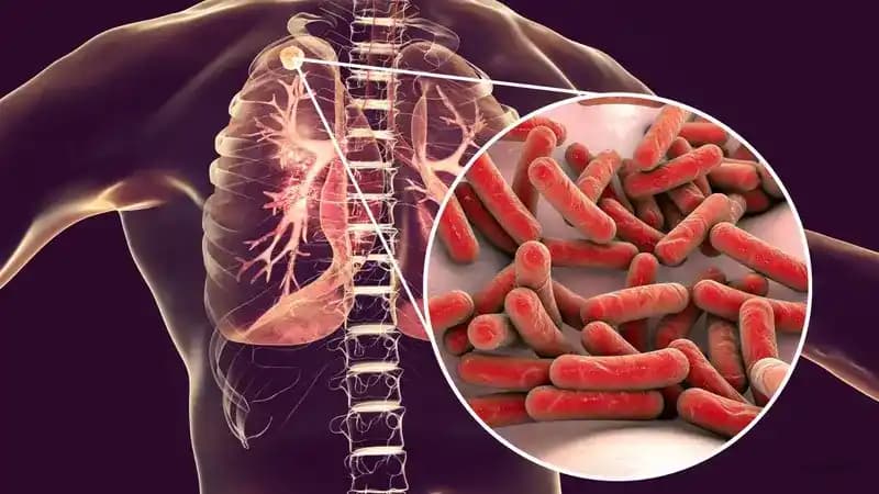 How Tuberculosis Actually Works: From Infection to Active Disease