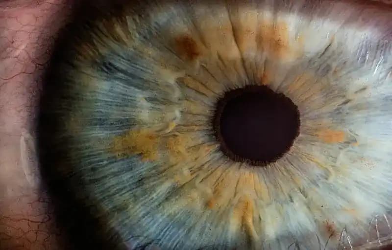 Morgagnian Cataract: A Comprehensive Guide